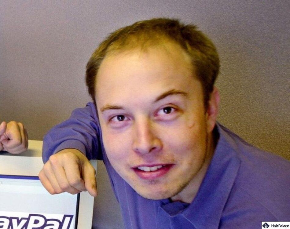 elon-musk-young-hairloss-1-1024x809.jpg