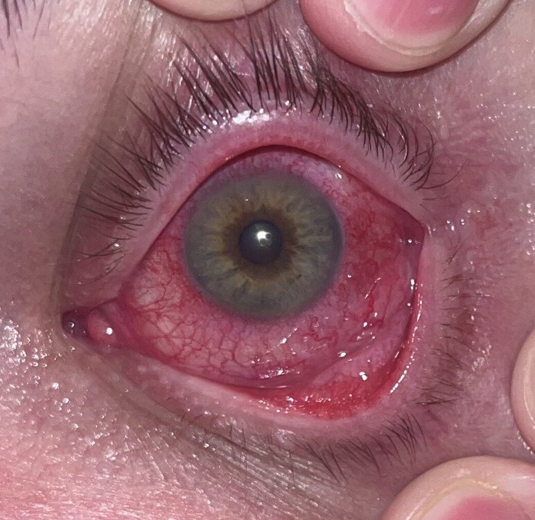 Uveitis April 2024 close up.jpg